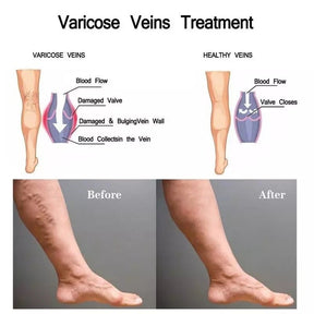 Vein treatment