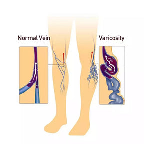 Vein treatment